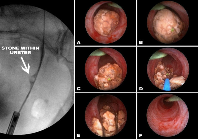 Laser Lithotripsy